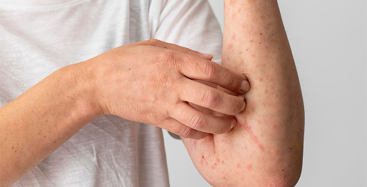 Man with red welts on his arm