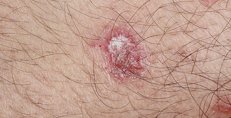 Actinic Keratosis