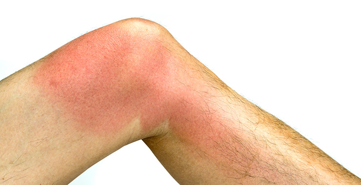Cellulitis Symptoms