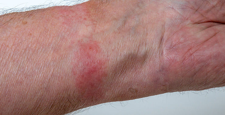 Contact Dermatitis symptoms