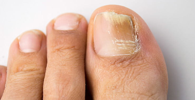 Fungal Nail Infection