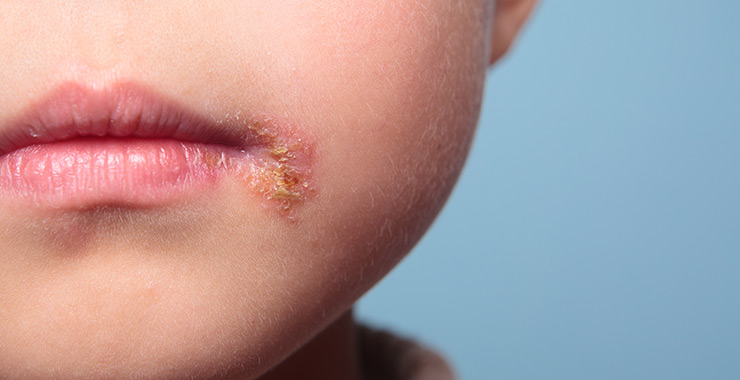 Impetigo Symptom