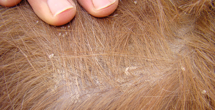 Seborrheic Dermatitis Symptoms