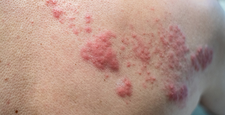 Shingles Symptoms
