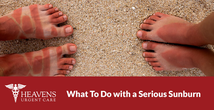 How to treat a serious sunburn