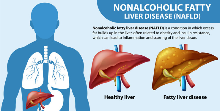 Nonalcoholic Fatty Liver Disease