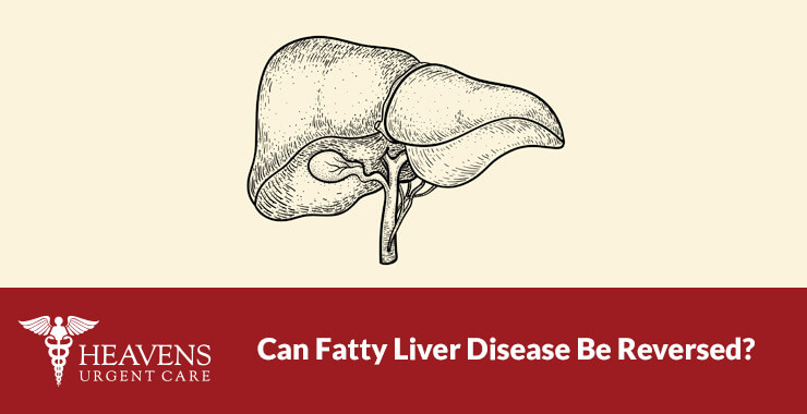 Can Fatty Liver Disease Be Reversed?